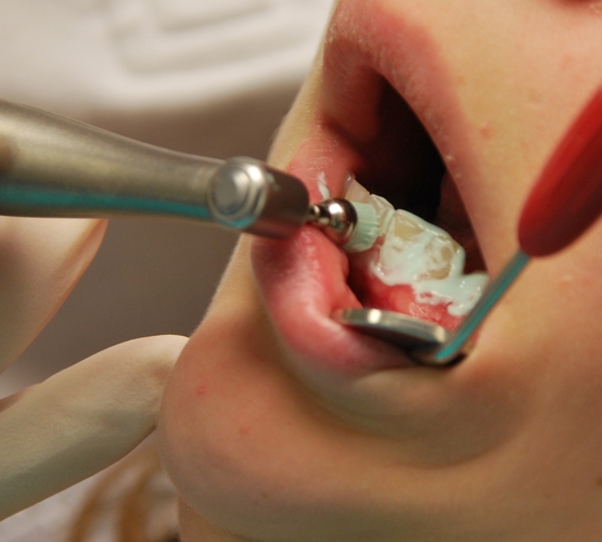 détarteur dentaire